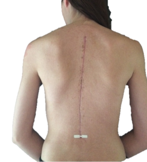 Surgical scar shown during followup appointment