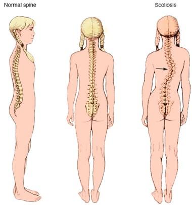 Illustration of scoliosis in a female child from either side and the back