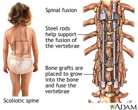 Illustration shows fused spine