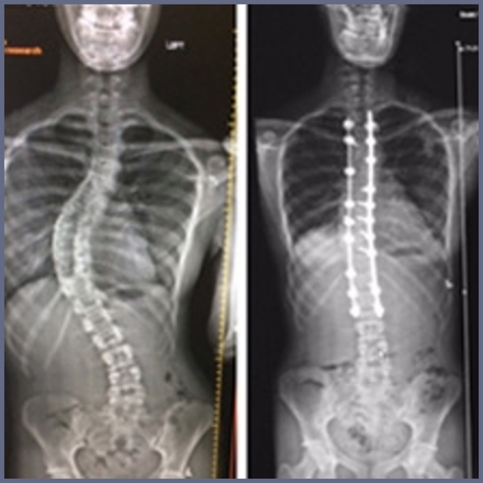 Xray shows spine with scoliosis on the left and the same spine corrected with spinal fusion on the right