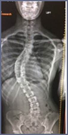 Courtney's xray of the spine