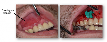 Gums before and after incision and drainage