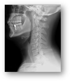 Xray of lower jaw, side of face