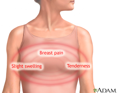 Illustration that shows a woman's breasts circled with the words, "Breast pain, slight swelling, and tenderness"