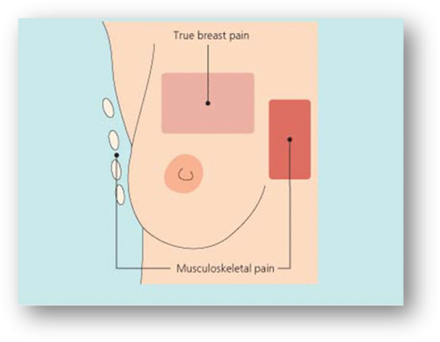 Illustration showing highlight box on a woman's breast with the words, "True breast pain" and a highlight box over the rib cage area with the words, "Musculoskeletal pain."