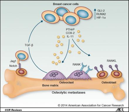 Illustration shows breast cancer cells invading a bone.