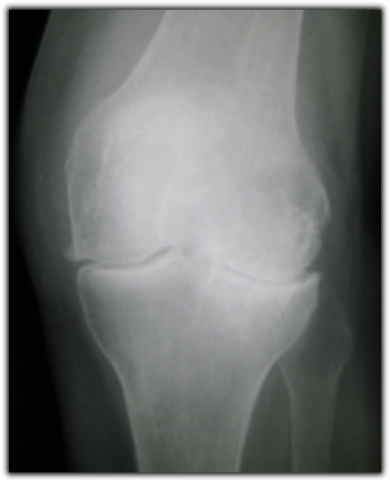 An X-ray exhibiting findings consistent with diagnosis of osteoarthritis: joint space narrowing that is often asymmetric, the presence of osteophytes and the development of subchondral sclerosis.
