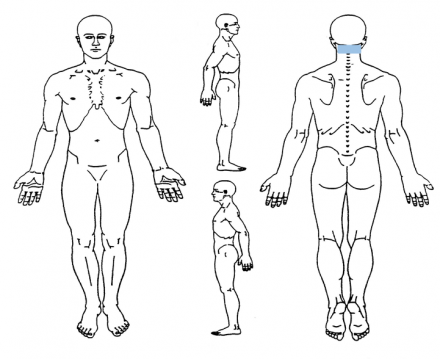 Image depicting outline of the body, with smaller highlighted area now where Luisa feels pain.