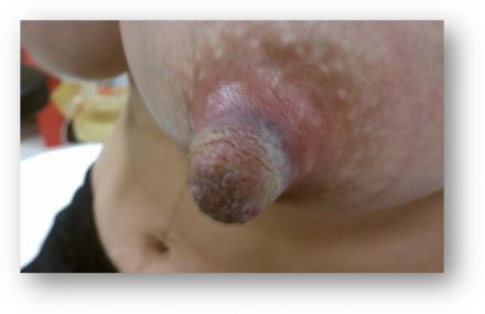 Image showing cracking of the nipple