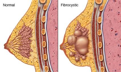 Illustration showing normal breast on the left and a breast with fibrocystic disease on the right.