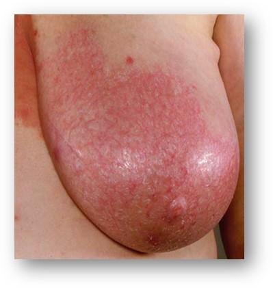 A breast inflamed and red from mastitis