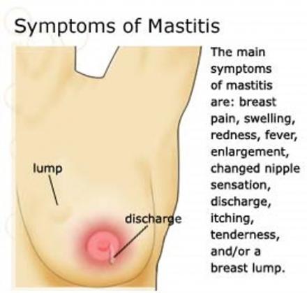Illustration shows a breast with a printed list of symptoms of mastitis: breast pain, swelling, redness, fever, enlargement, changed nipple sensation, discharge, itching, tenderness, and/or a breast lump.