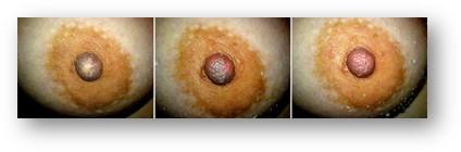 Image showing Raynaud's of the nipple, with an orange-looking areola and purple nipple