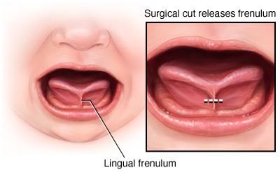 Illustration shows short frenulum on an infant, with a series of dots indicating a surgical cut midway up the frenulum to release the tongue for greater movement.