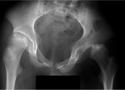 XRAY of Nestor's hips that shows a left hip dislocation.