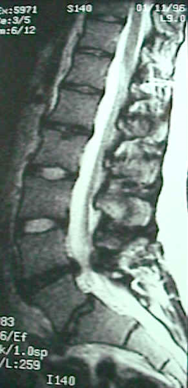 Sagittal Image of lumbar spine