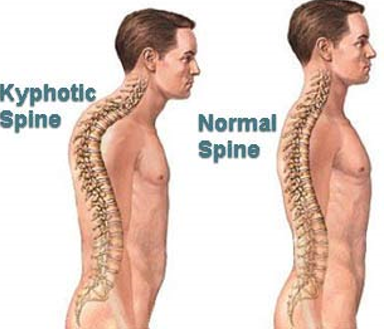 Illustration shows a kyphotic spine as more rounded at the top than a normal spine