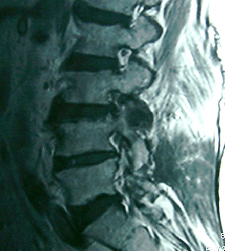 Foramenal stenosis