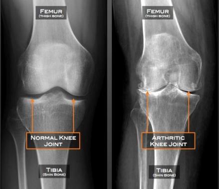 Xrays show knee without arthritis versus a knee with arthritis