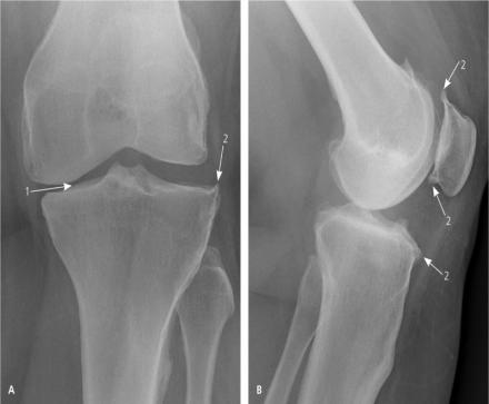 Xrays show joint space narrowing and examples of osteophyte formation