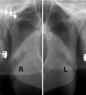 Panoramic xray shows the left versus right temporomandibular joints