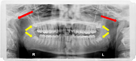 Panoramic radiograph with arrows that show the position of the temporomandibular joint and unerupted third molars