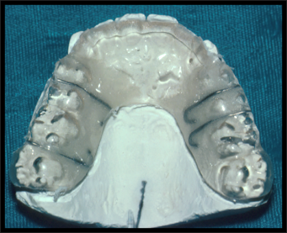 Maxillary occlusal splint template