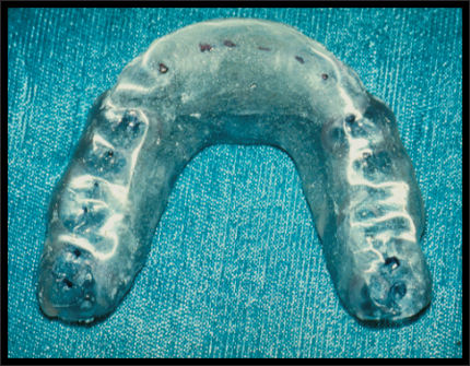 Maxillary occlusal splint adjusted with acrylic for occlusion