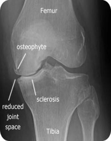 Xray shows radiological findings consistent with osteoarthritis