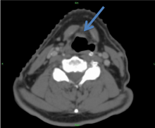 CT scan of thyroid cancer