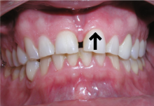 Gingival area of the left maxillary incisor.