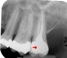 Radiograph of a molar